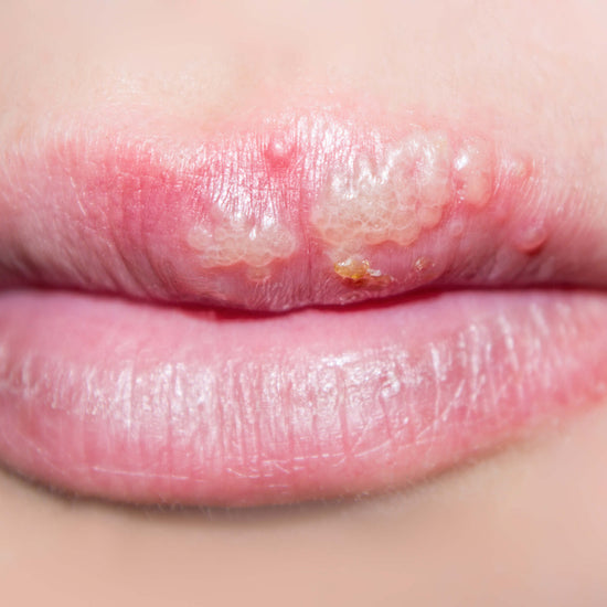 How To Get Rid Of A Cold Sore In 3 Days.