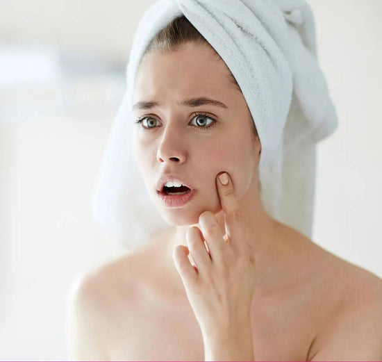 How to Heal and Prevent Those Pesky Breakouts